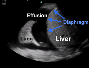 Pleural Effusion Ultrasound