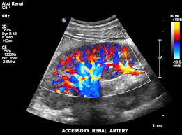 Renal Doppler