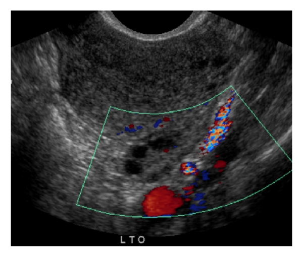 Pelvic Ultrasound