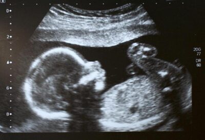 Baby Growth Scan - Anytime After 6 Weeks (Incl Gender after 16 weeks)